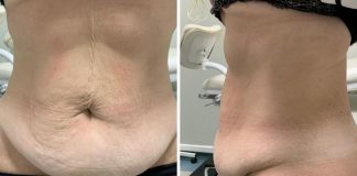 Após fazer bariátrica, moradora de Brusque realiza abdominoplastia pelo SUS no Hospital Azambuja